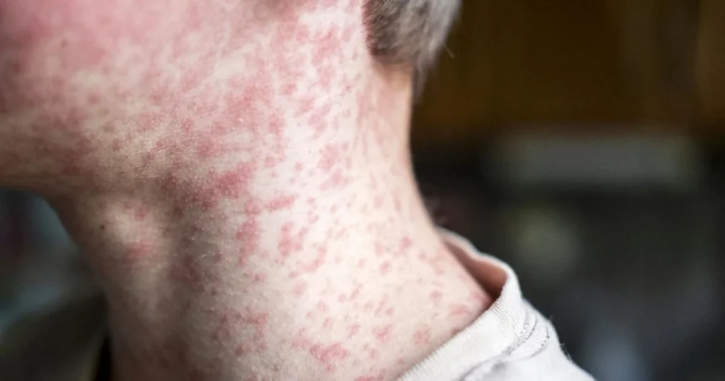 Utah Is Now America's Measles Epicenter — and a Disease Declared Gone 26 Years Ago Is Back With a Vengeance